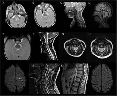 Excellent Response to Plasma Exchange in Three Patients With Enterovirus-71 Neurological Disease